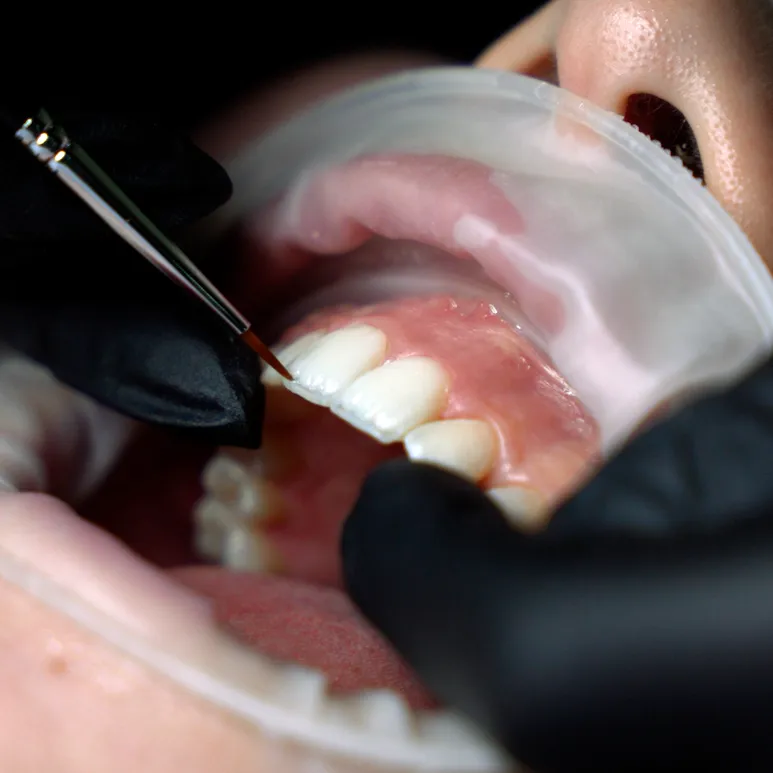 Faccette dentali in composito