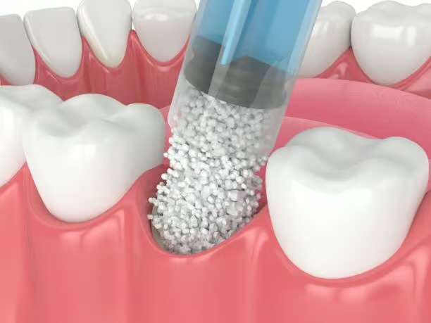 Illustrazione di un innesto osseo dentale