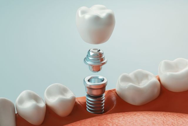 Illustrazione di un impianto dentale singolo